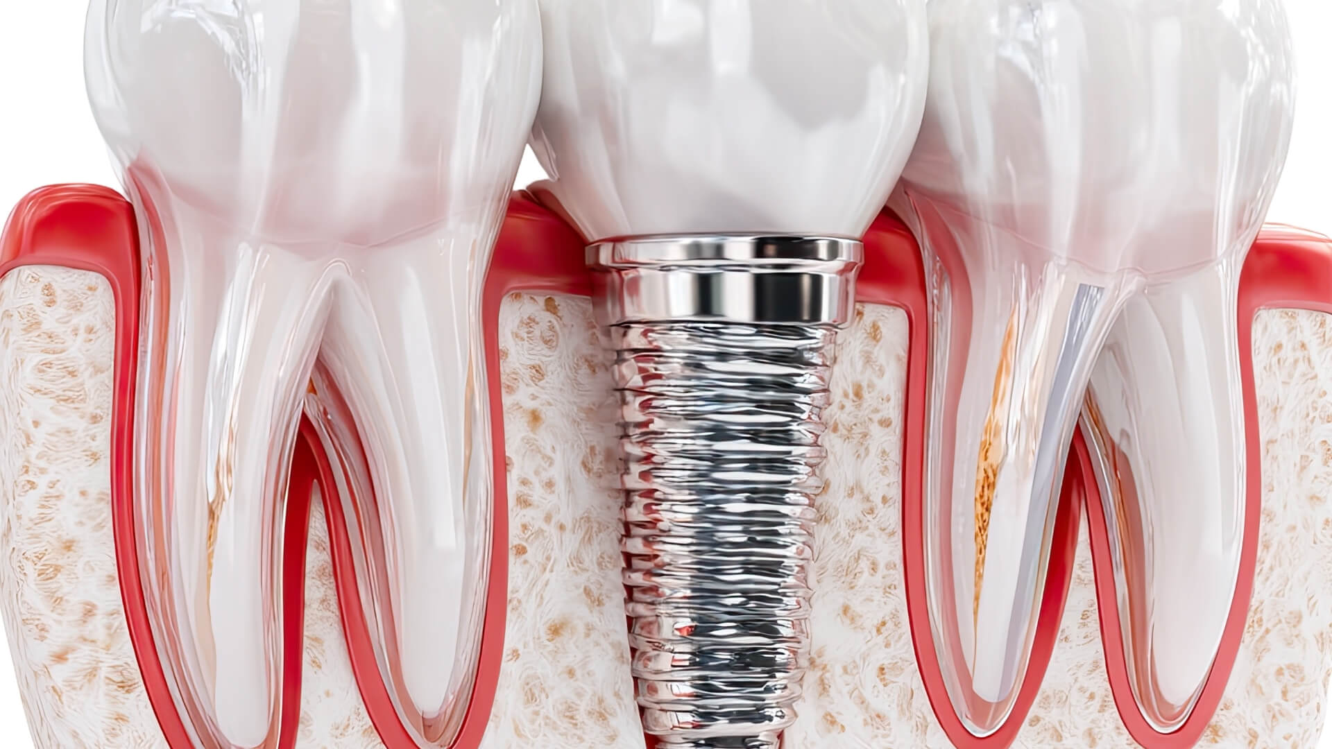 alkol tuketimi implant iyilesmesini nasil etkiler Alkol Tüketimi İmplant İyileşmesini Nasıl Etkiler?