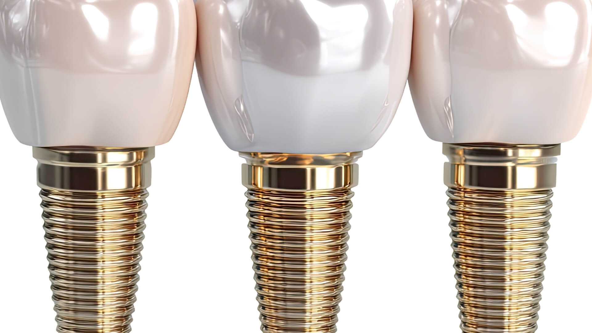 Aynı Gün İmplant (Immediate Implant) Nedir?