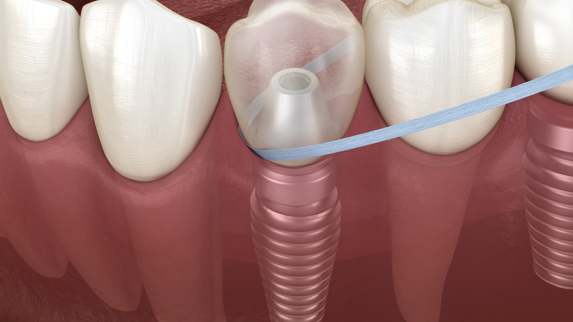 Dişçi Korkusu (Dental Fobi) Olanlar İçin Sedasyonlu İmplant