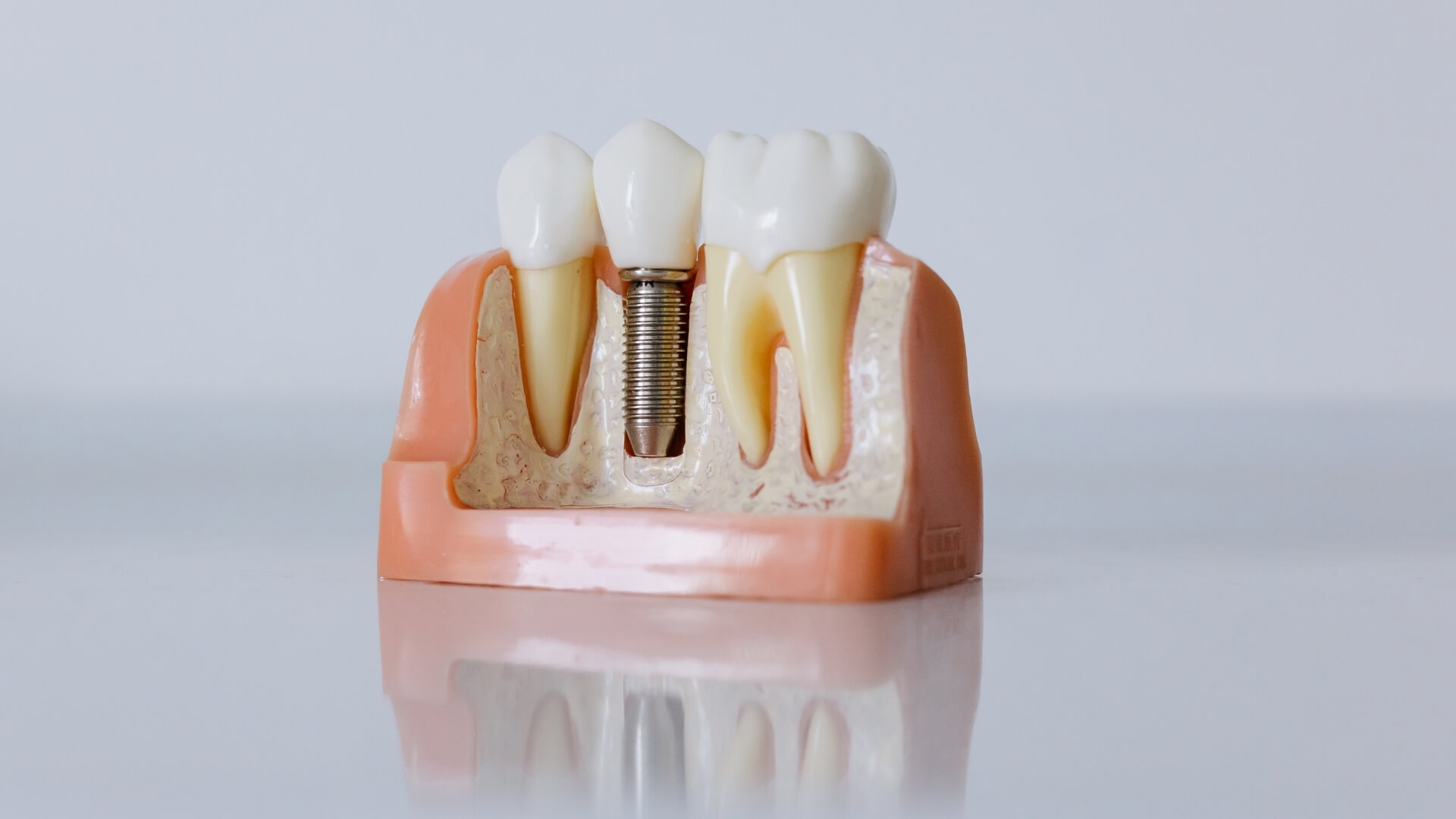 implant tedavisi hakkinda dogru bilinen 10 yanlis İmplant Tedavisi Hakkında Doğru Bilinen 10 Yanlış