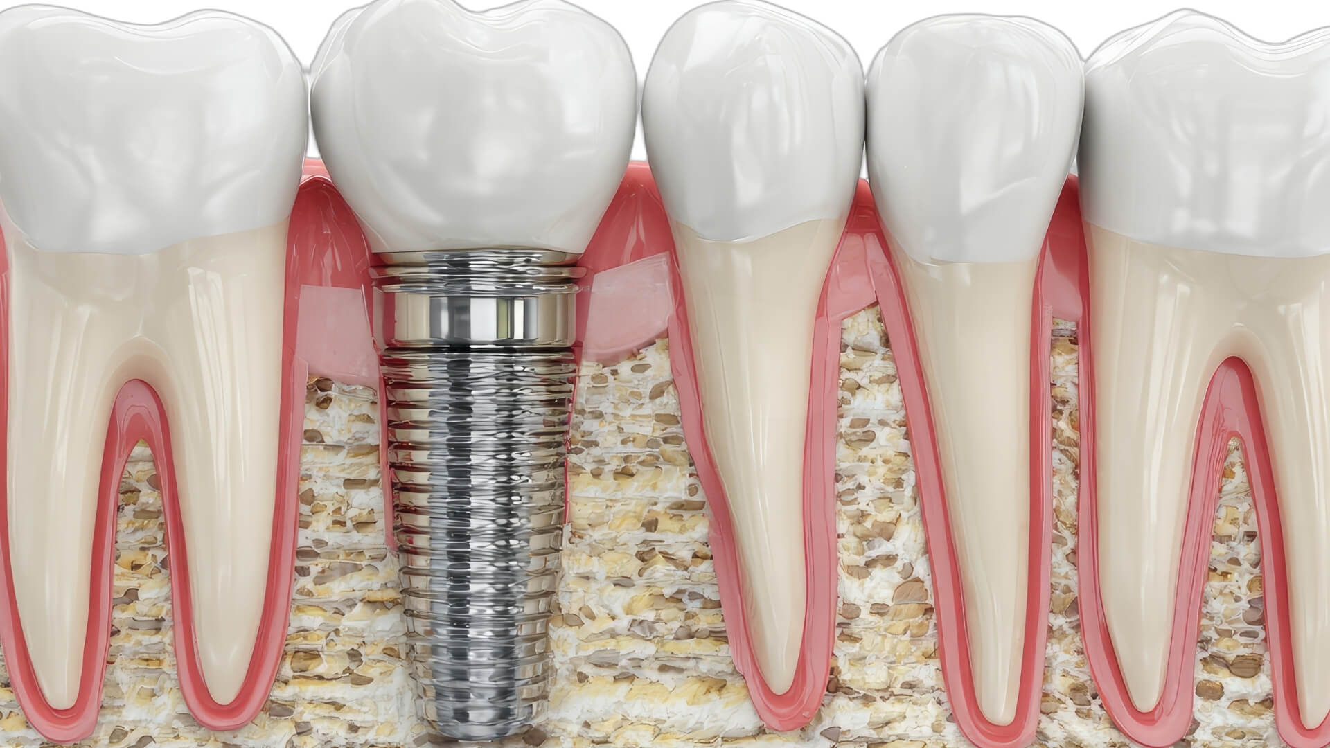 Kemik Tozu (Graft) Uygulaması Nedir? Ne Zaman Gereklidir?